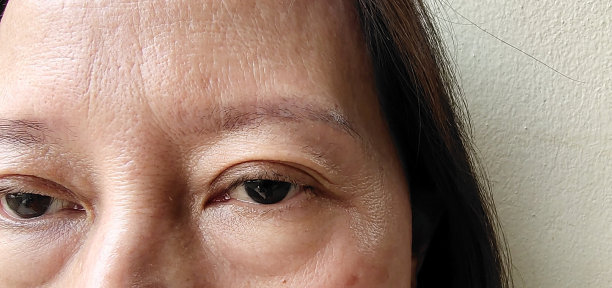 脸上的松弛、脂肪下垂和皱纹瑕疵。图片下载