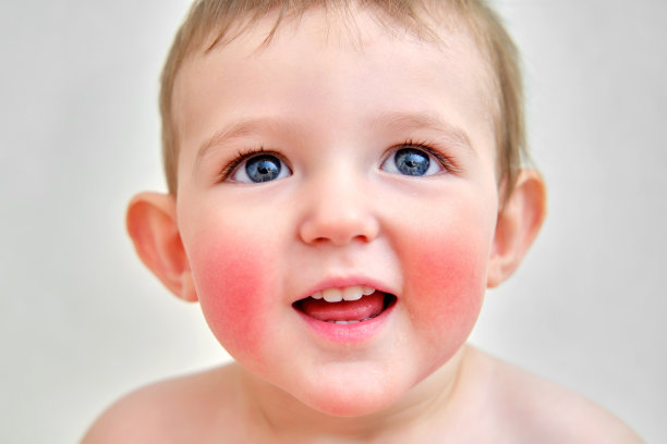 一个脸颊和下巴过敏的孩子的肖像。蹒跚学步的男孩过敏，红脸皮肤，白色背景图片下载