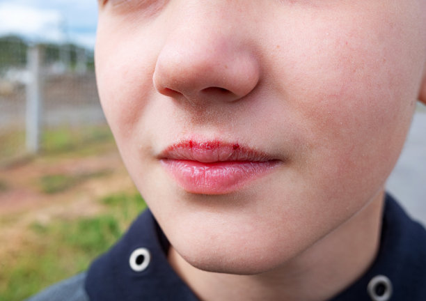 患病儿童的肖像，严重干燥出血，嘴唇开裂或皲裂。图片下载