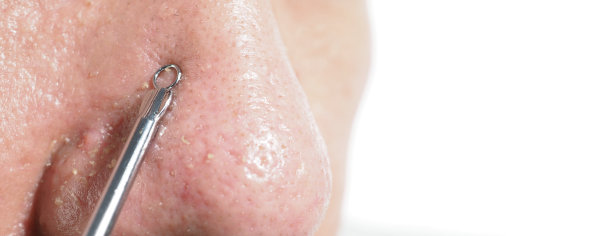 粉刺和毛孔问题。用不锈钢医用祛痘工具挤压黑头粉刺。压迫鼻子毛孔的白色和黑头粉刺。痤疮皮肤问题特写。皮肤护理治疗。图片下载