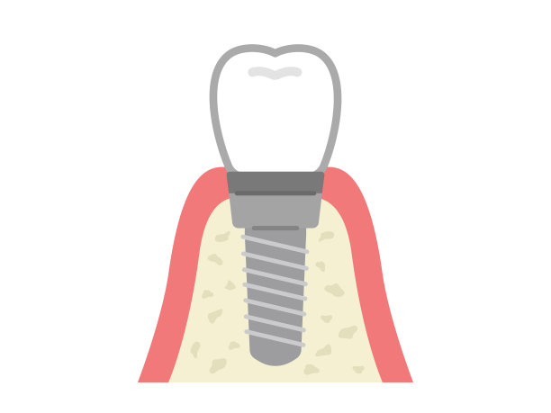 植入牙的插图。图片下载