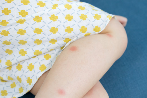 小女孩有皮疹过敏，腿上痒图片下载