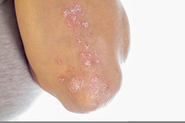 肘部银屑病。密切自身免疫性不治之症皮肤病银屑病。肘部发炎、片状皮疹。受银屑病关节炎影响的关节。图片下载