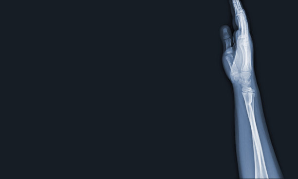 手部和手腕关节的x线图像，以查看损伤肌腱和桡骨结合骨折的医学诊断。医学影像概念与复制空间。图片下载