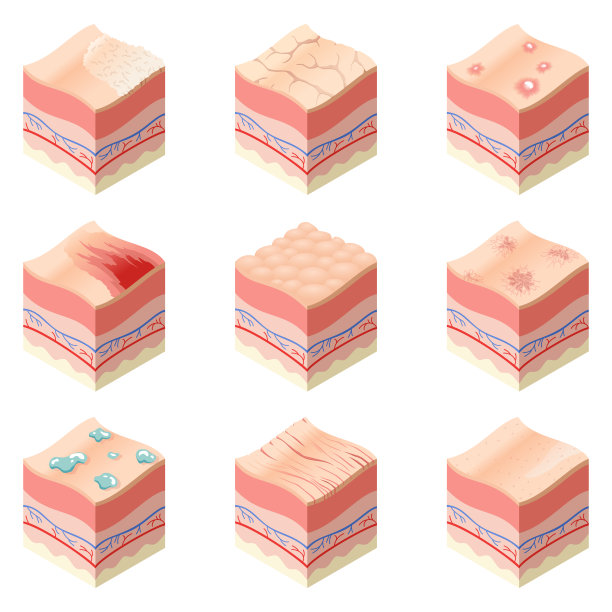 护肤品医学概念。人体皮肤横截面水平层结构中不同皮肤类型的一组问题。解剖学说明模型层的皮肤图片下载