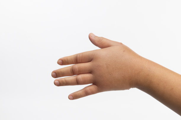 因昆虫叮咬过敏而肿胀的手。皮肤过敏。图片下载