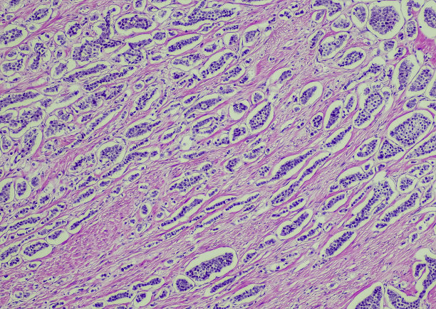 分化良好型的神经内分泌肿瘤图片下载