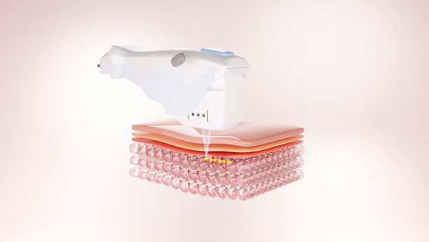 Hifu激光处理射到SMAS层图片下载