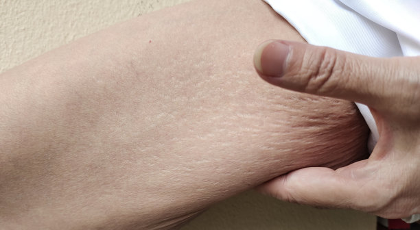 松弛的脂肪下垂的皮肤，皱纹和腿下松弛的皮肤。图片下载