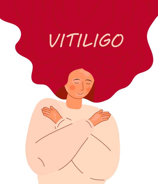 白癜风概念矢量为网络，应用程序。世界白癜风日插图。皮肤病和皮肤病问题。图片下载