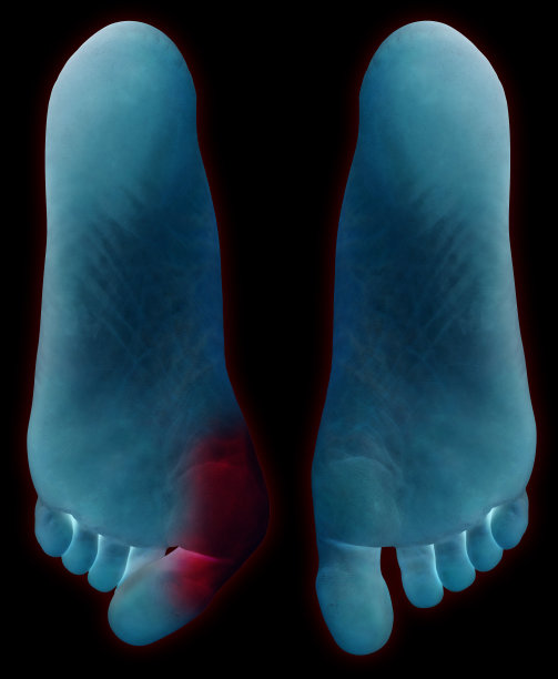 双足，有无拇外翻，用红色突出图片下载