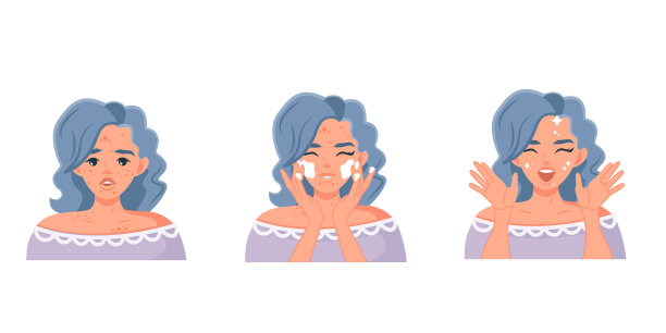 治疗痤疮。女孩洗净了皮肤图片下载