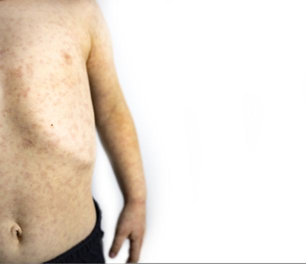 白色背景下孩子身上的皮疹。图片下载