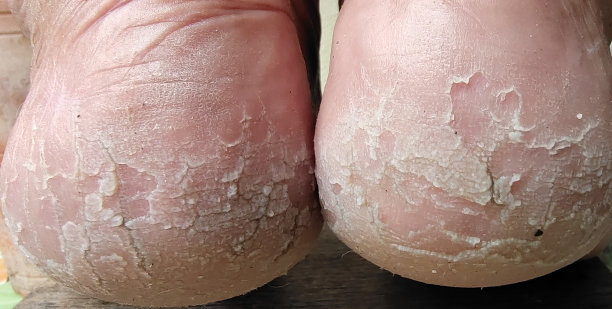 鞋跟开裂，皮肤发炎。图片下载