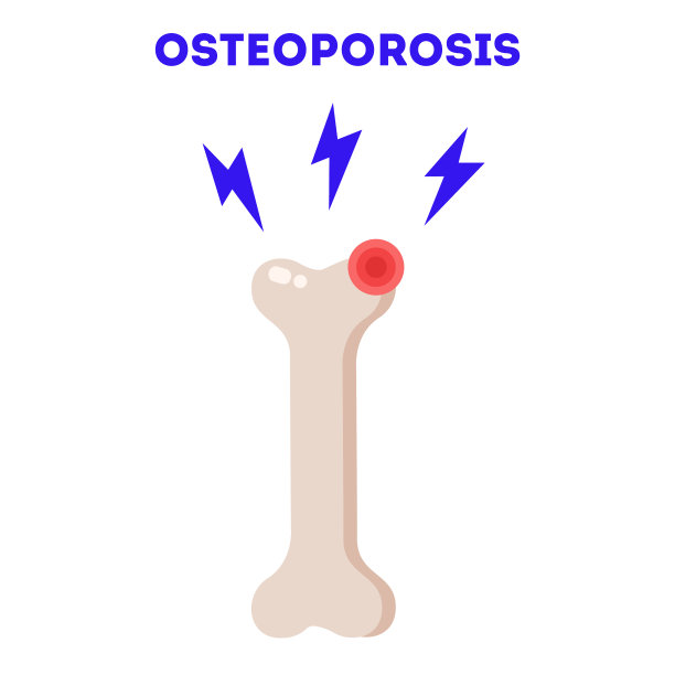 骨质疏松症载体图。医学矫形海报，配有骨骼插图，标语为骨质疏松症。骨量减少。预防骨骼疾病图片下载