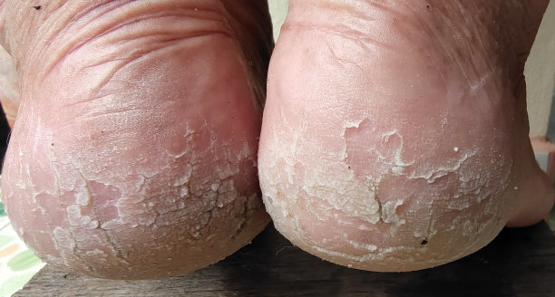 鞋跟开裂，皮肤发炎。图片下载