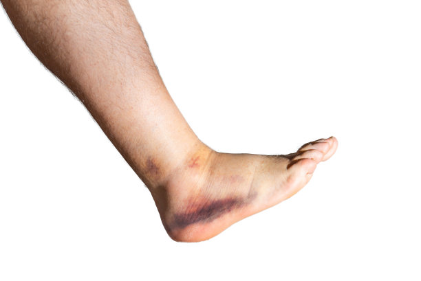扭伤和肿胀的脚踝。男人在家里扭伤了脚踝。脚踝扭伤，受伤，孤立的白色背景。图片下载