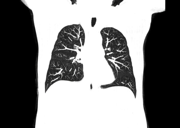 医院放射科的胸部或肺部CT扫描，用于检测新型冠状病毒图片下载