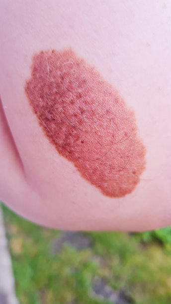 棕色胎记图片下载