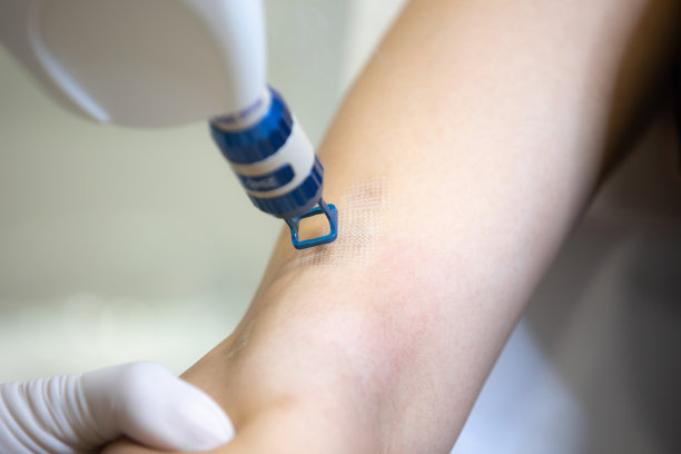 用激光去除皮肤上的毛发或疤痕。二氧化碳的技术。图片下载