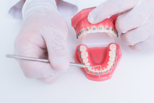 正畸医生展示牙齿上的牙套系统是如何排列的图片下载