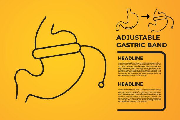 可调节胃带设计减重手术载体的图解图片下载