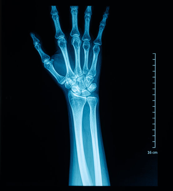 手掌x光片图片下载