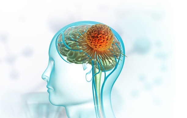 脑瘤医学概念图片下载