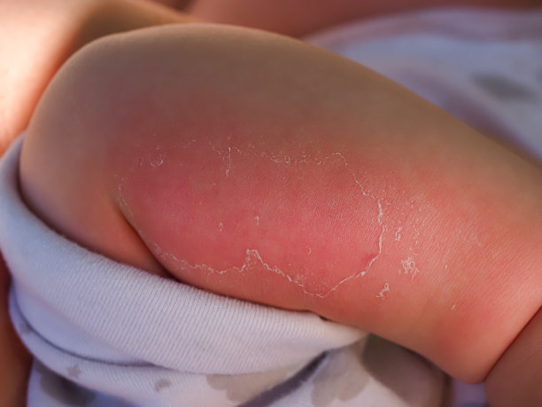 红手小孩宝宝皮肤近距离晒伤。孩子手臂上的皮肤剥落图片下载