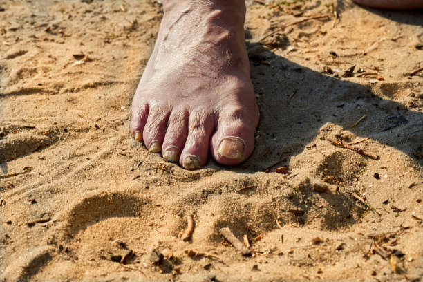 一个老人的脚在夏天的沙滩上，指甲很脆，很疼图片下载