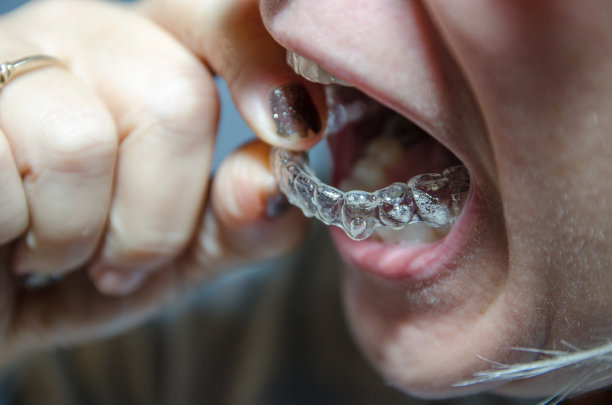 一个女人移除塑料隐形牙套的特写镜头。图片下载