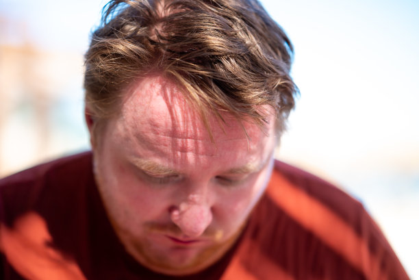 银屑病青年男子额头特写。景深小。高质量照片图片下载