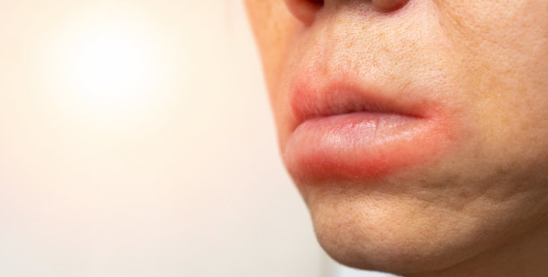 口腔皮肤过敏，嘴唇红肿、起疹，亚洲女性感染或疾病引起的皮肤问题。过敏性皮炎医疗保健概念。图片下载