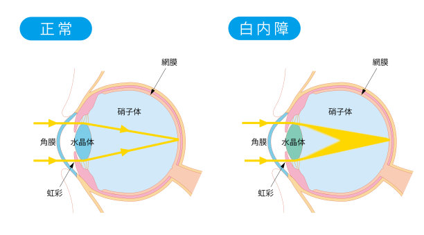 正常眼和白内障眼的横切面图片下载