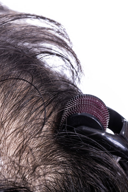 微针脱发治疗秃头再生头发图片下载