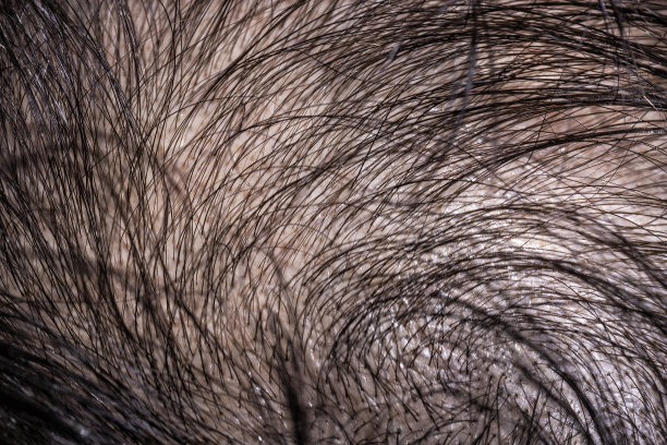 脱发，头发稀疏，开始秃顶图片下载