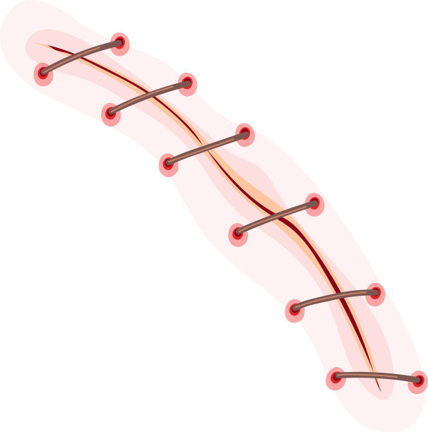 手术缝合身体，伤口有血痕图片下载