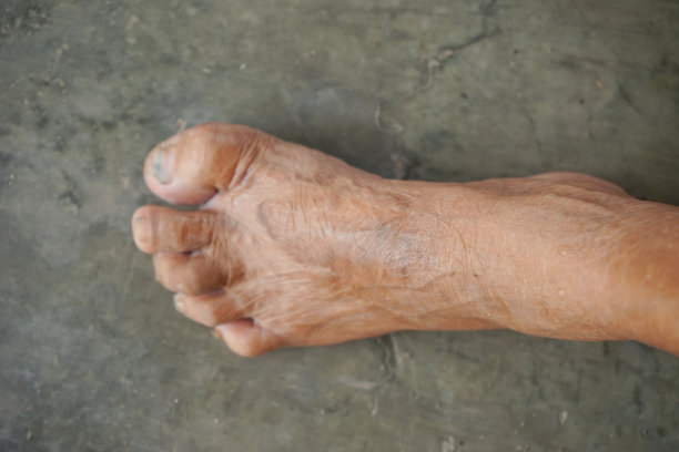 印尼老妇人的脚，脚趾弯曲图片下载
