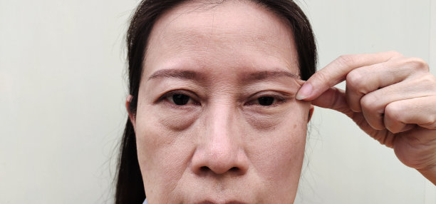 松弛性脂肪下垂皮肤下垂皮肤松弛，脂肪团和袋子，黑斑和瑕疵在脸上。图片下载