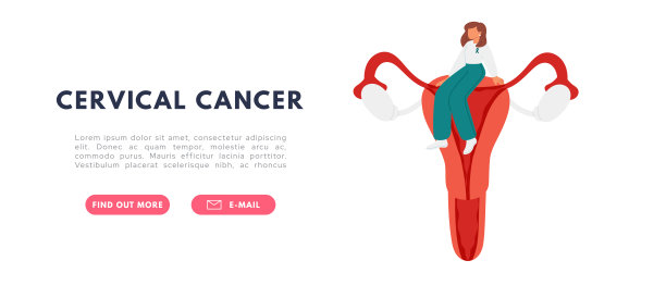 子宫颈癌概念。疾病症状。HPV感染发展。平面矢量图图片下载
