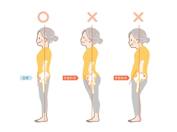 一位老年女性的好姿势和坏姿势样本——骨盆图片下载