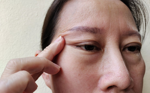 脂肪下垂，眼睑下垂，脂肪团，眼袋。图片下载