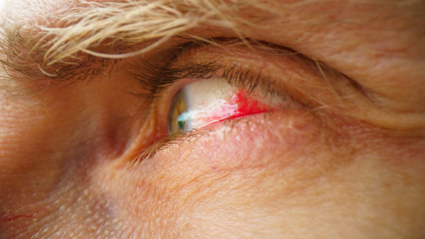 眼睛血管破裂闭合图片下载