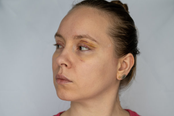 女性整容后面部恢复，眼睑成形术后，可见眼部伤口割伤，眼袋肿胀，皮肤缝合线肿胀，眼睑淤青。去除皮肤多余脂肪的整容手术图片下载