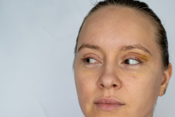 女性整容后面部恢复，眼睑成形术后，可见眼部伤口割伤，眼袋肿胀，皮肤缝合线肿胀，眼睑淤青。去除皮肤多余脂肪的整容手术图片下载