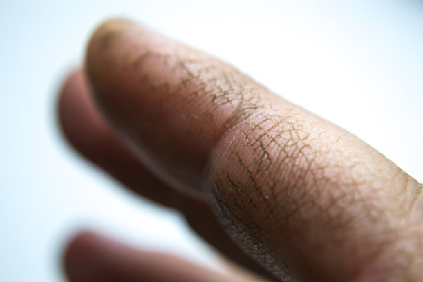 一名男子手部皮肤极度干燥、脱水和开裂，表皮碎片脱落，原因是在Covid-19大流行期间过度使用含酒精的消毒剂。图片下载