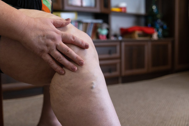 成熟的女人按摩她的腿静脉曲张。图片下载