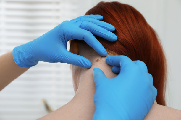 皮肤科医生在临床检查病人的胎记，特写图片下载