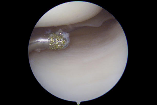 半月板撕裂修复前用金刚石锉刀清创的关节镜观察图片下载