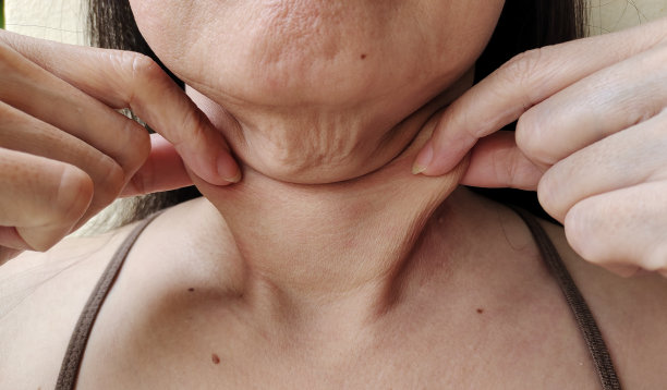 松弛的皱纹皮肤下的颈部，下巴下的赘肉和脂肪团，在女人的身体上的痣。图片下载